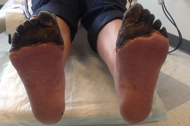 pre-surgical limb salvage before